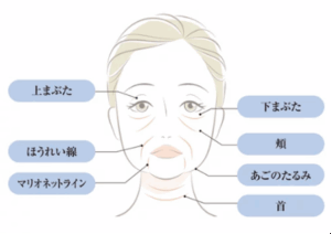 たるみ