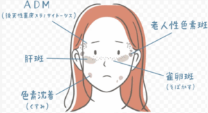 しみ・そばかす