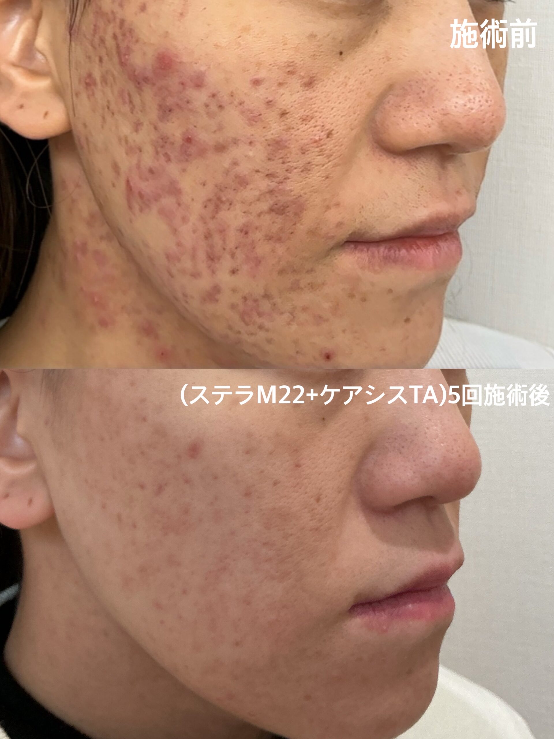 繰り返すニキビに悩んでいませんか？