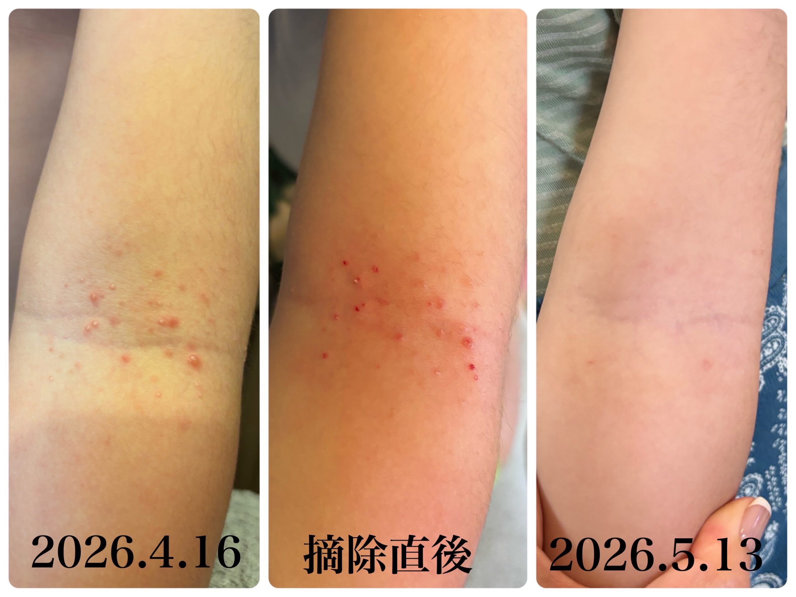 【息子の水いぼ治療レポ】摘除後の経過と、水いぼクリームの効果✨