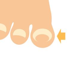 👣 巻き爪でお悩みの方へ✨